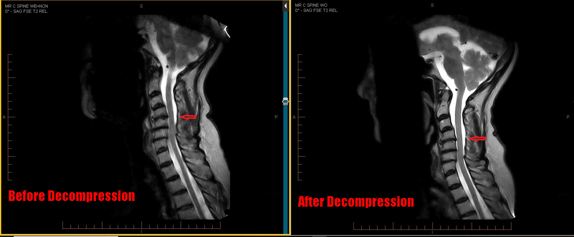 Cervical spine MRI before and after nonsurgical spinal decompression at Henry Clinic, Greenville, SC