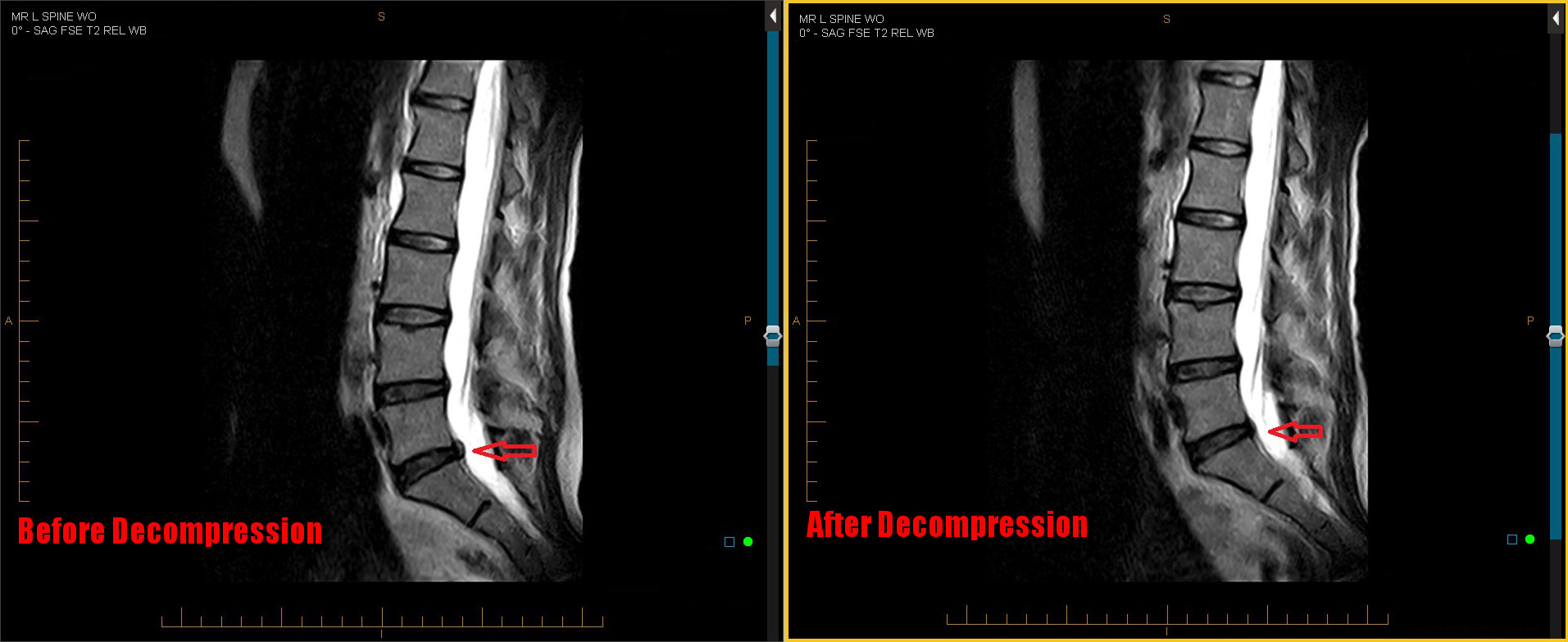 Lumbar spine MRI before and after nonsurgical spinal decompression at Henry Clinic, Greenville, SC